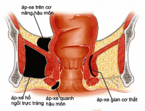 Bệnh Apxe hậu môn là gì cách điều trị hiệu quả