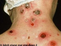 bệnh giang mai có nguy hiểm không